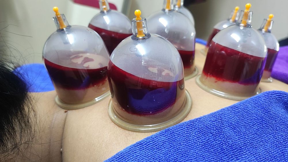 Оздоровительная хиджама.