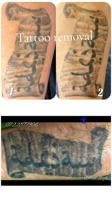 Stergere tatuaje la nivelul sprancenelor si corporale.