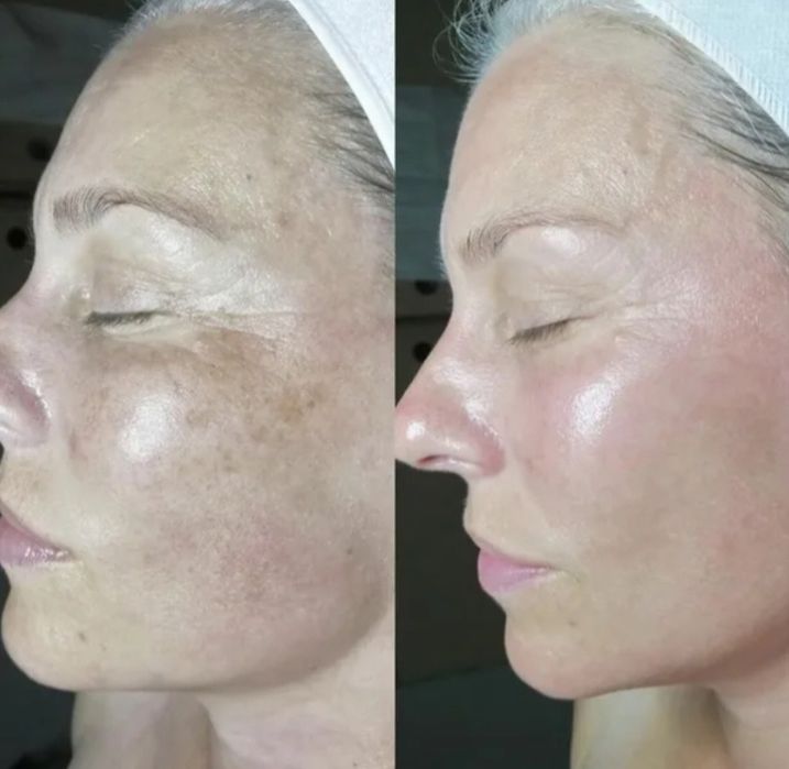 Карбоновый пилинг,7000  омоложение