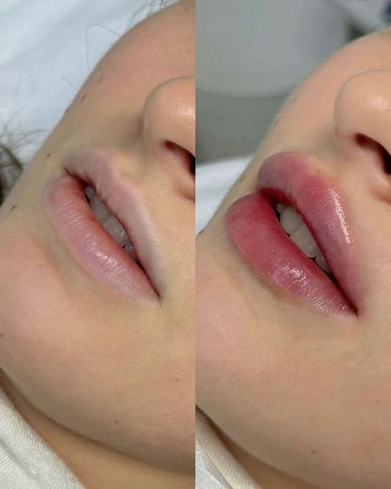 Увеличение губ Алматы 25000
