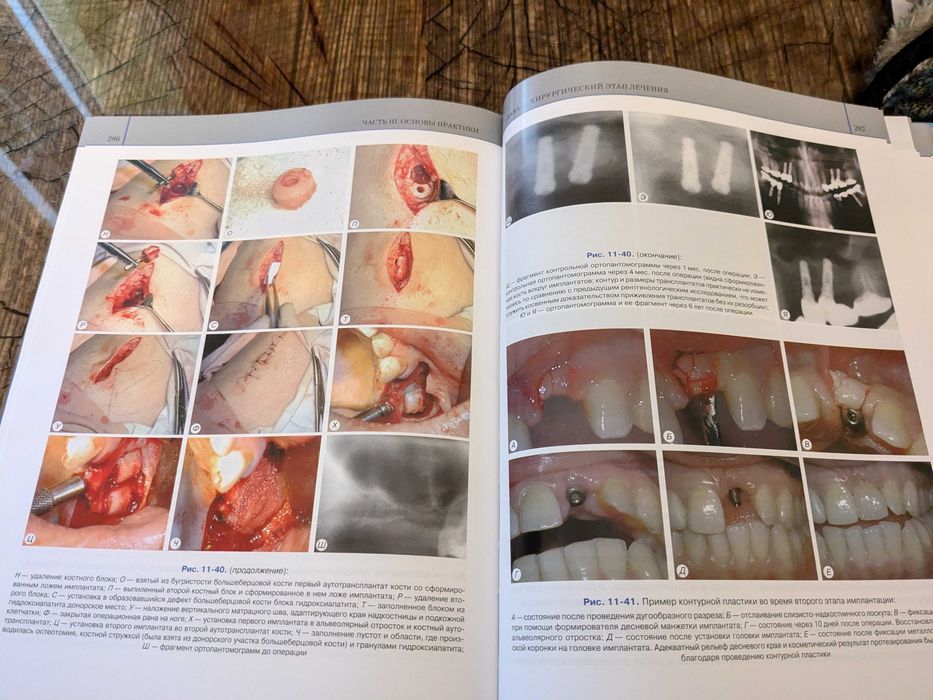 Дентальная имплатология