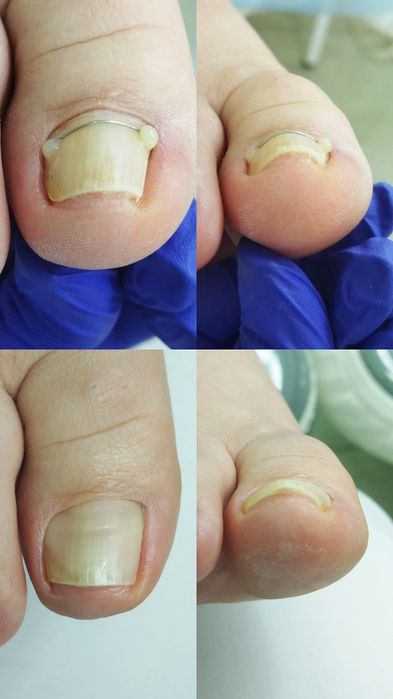 Педикюр, подолог