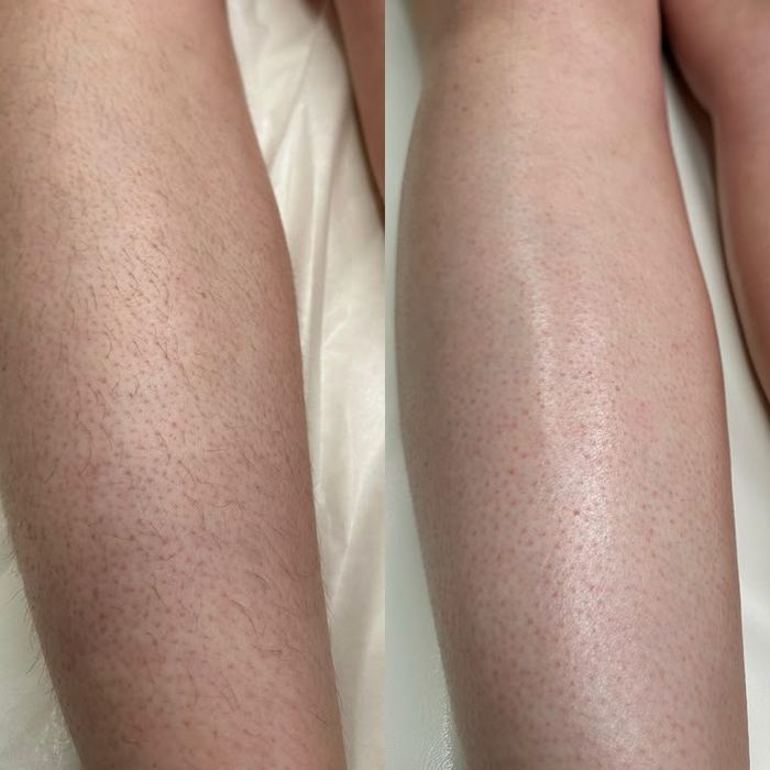 Лазерный Эпилятор