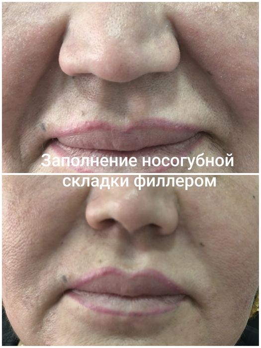 Красота это -губки бантиком на новый год! Botox full face