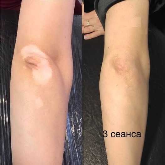 Vitiligo dog'larini kamuflyaj bilan yopish