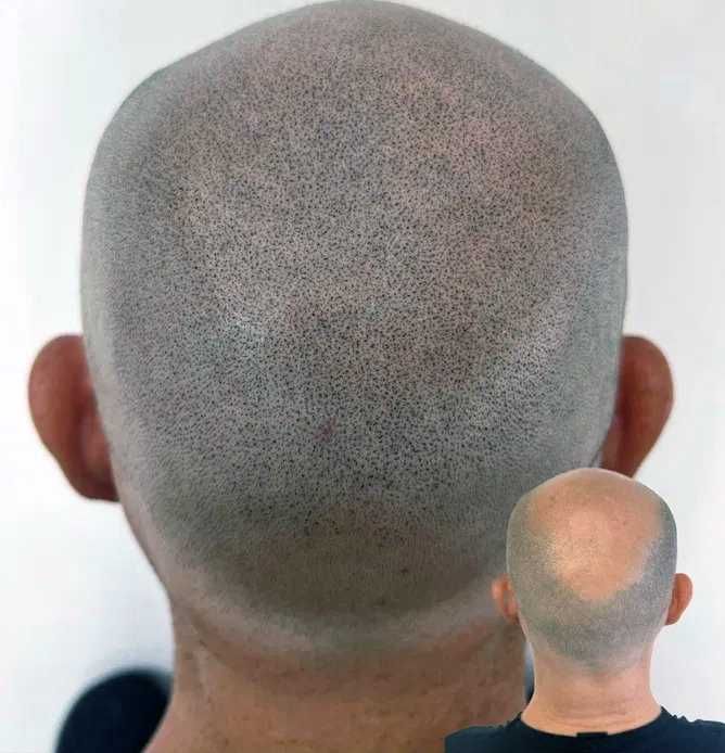 Caut modele pt. micropigmentare scalp chelie / păr rar -  tarif redus