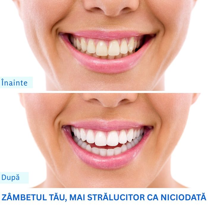 Kit de abire dinti - Set 10 seringi albire dentara