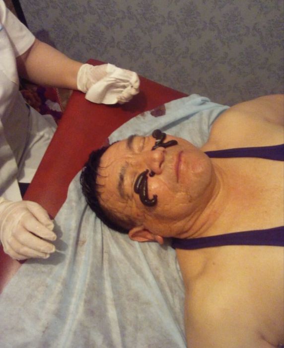 Хиджама, Гирудотерапия (сүлік салу емі)