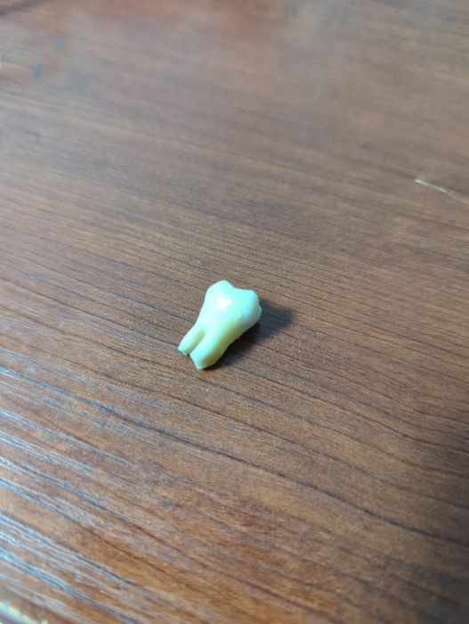 Зуб мудрости в отличном состоянии