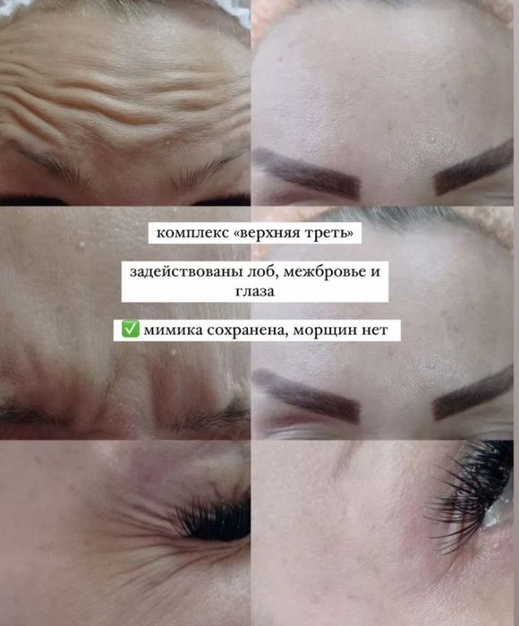 Ботокс. Лоб,межбровка,глаза