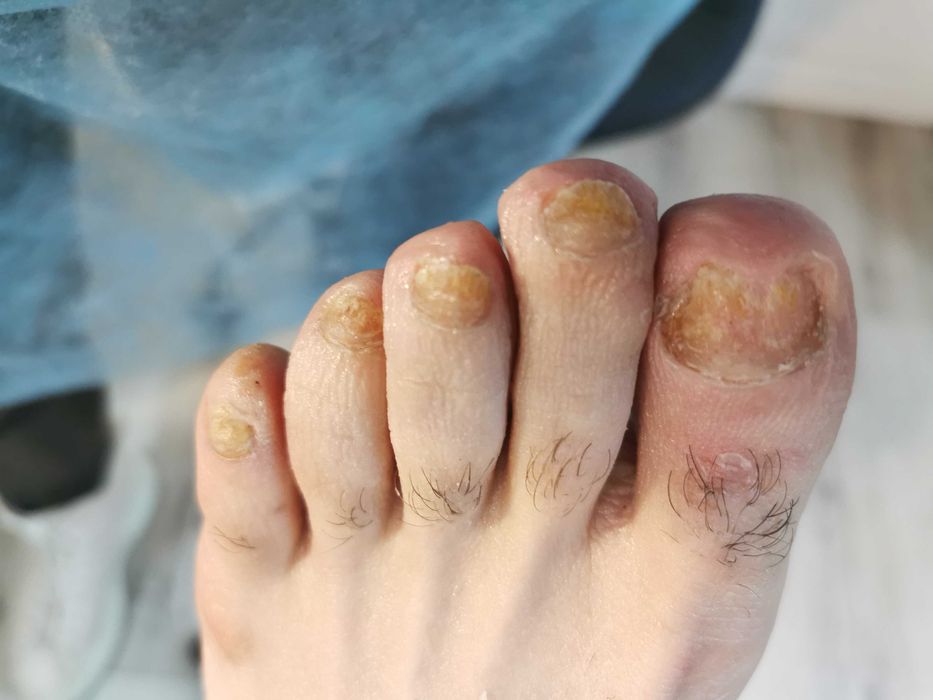 Cabinet pedichiura complexa /onicomicoze /unghii încarnate Alb