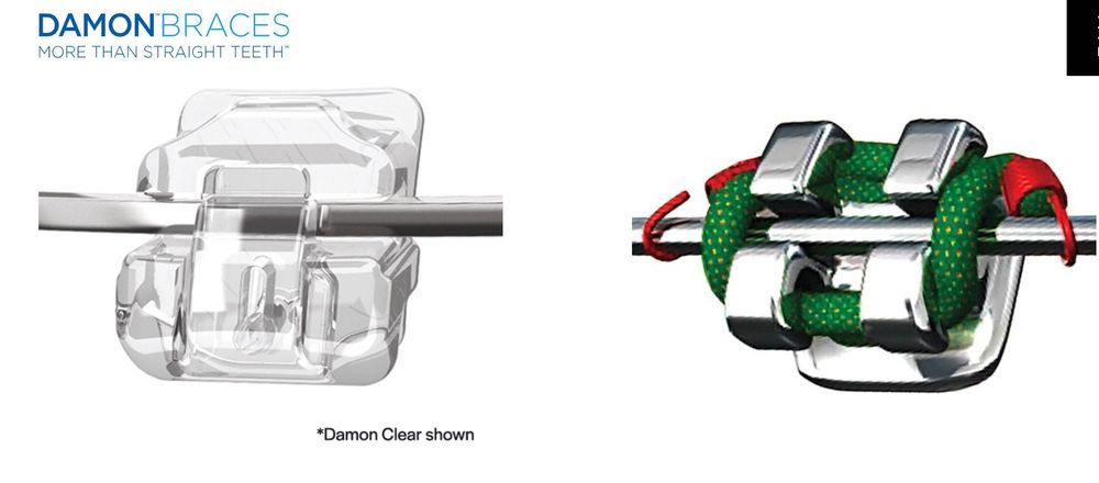Damon Braces aparat ortodontie Damon indreptat dinti