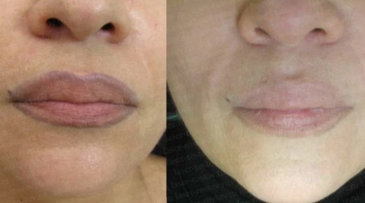 Удаление лазером тату от 5000