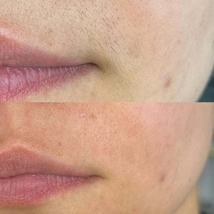 Лазерный Эпилятор