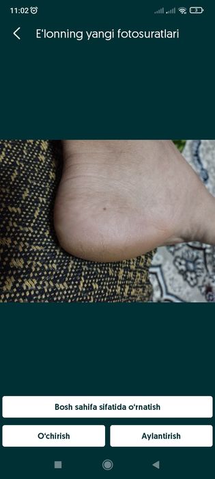 Tovon tirsak oyoq qoʻl yorilishini oldini olib va ulardan xalosboʻlish