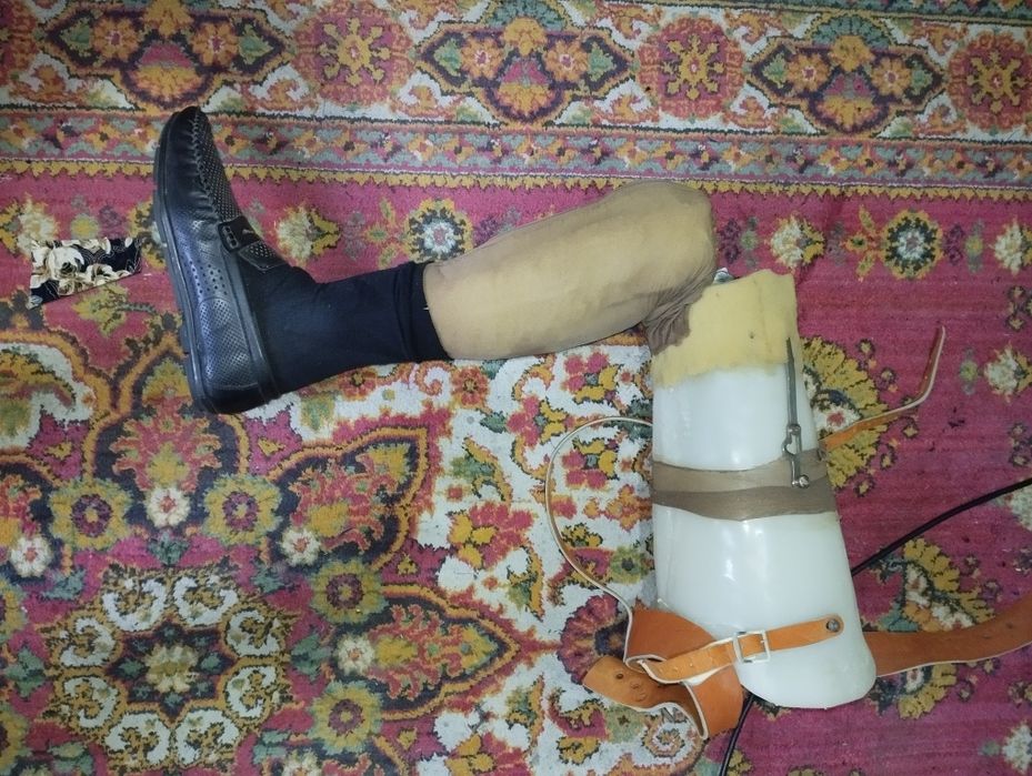 Протез левой ноги выше колени