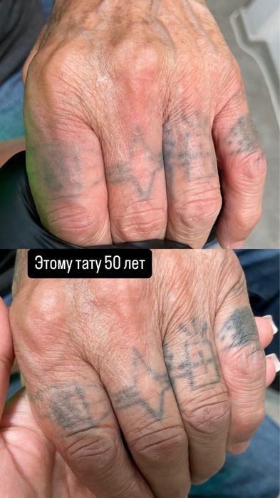 Удаление тату и татуажа