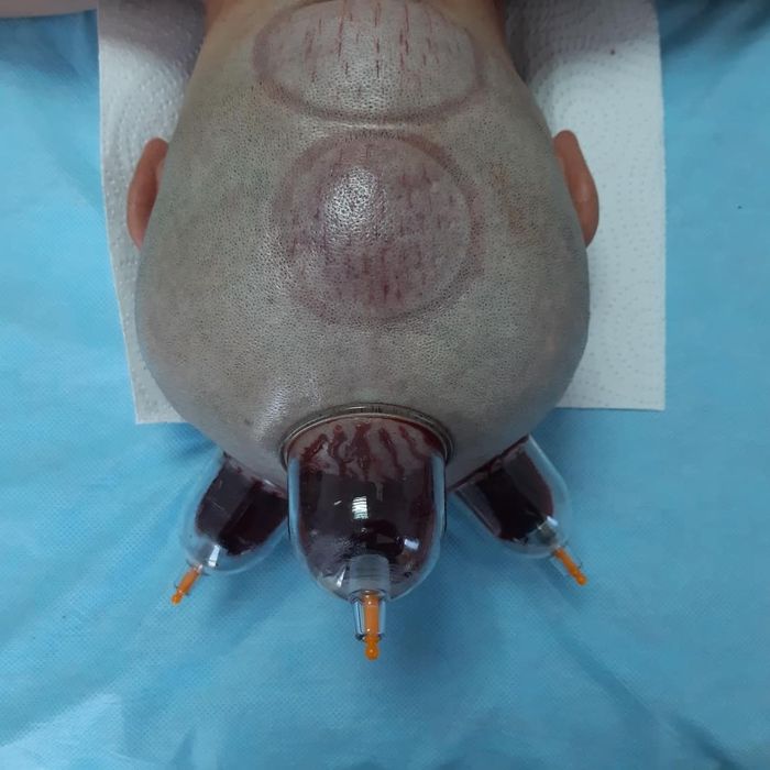 хиджама лечение по сунне.