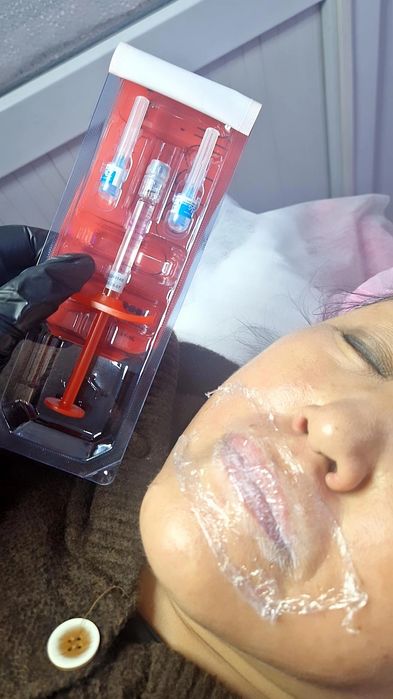 Увеличение губ Косметолог