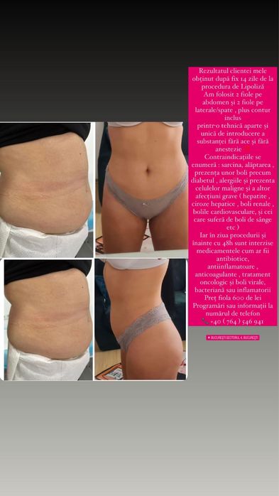 Lipoliză Injectabilă Fără Ac