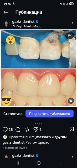 Имплант салу . Алматы