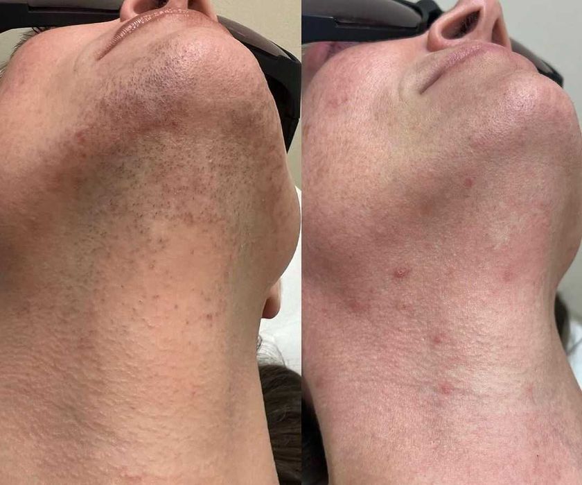 Лазер за епилация под наем