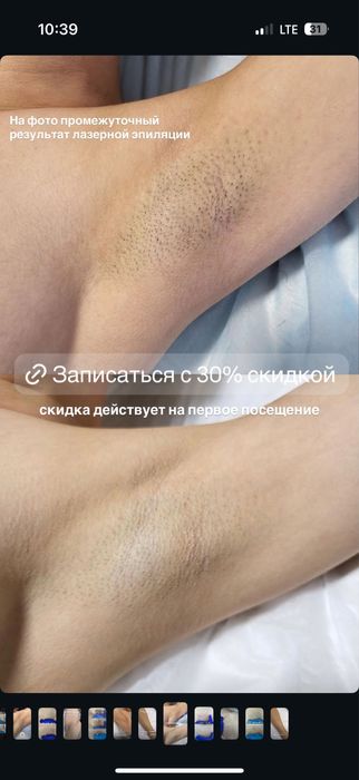 Лазерная эпиляция