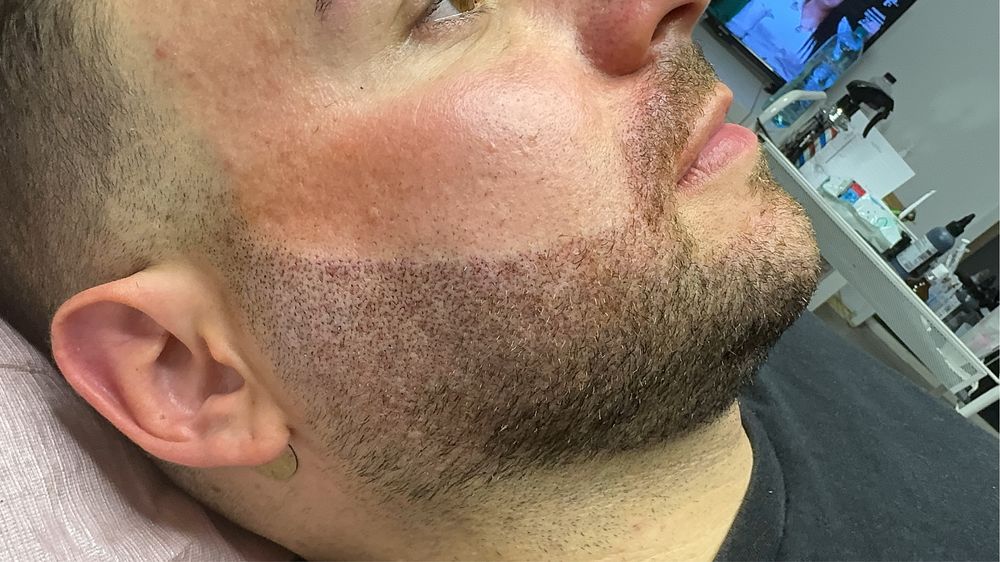 Micropigmentare scalp si barba indesire par tatuaj alopecie chelie