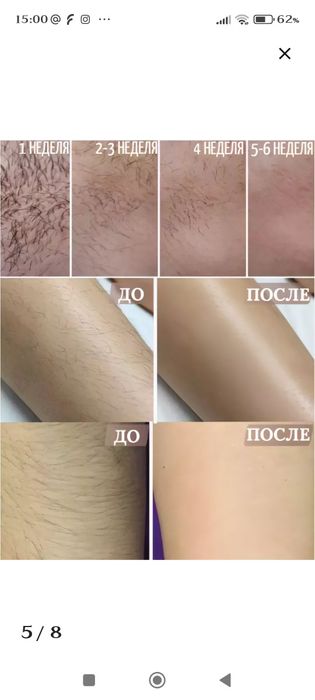 Фотоэпиллятор лазерный