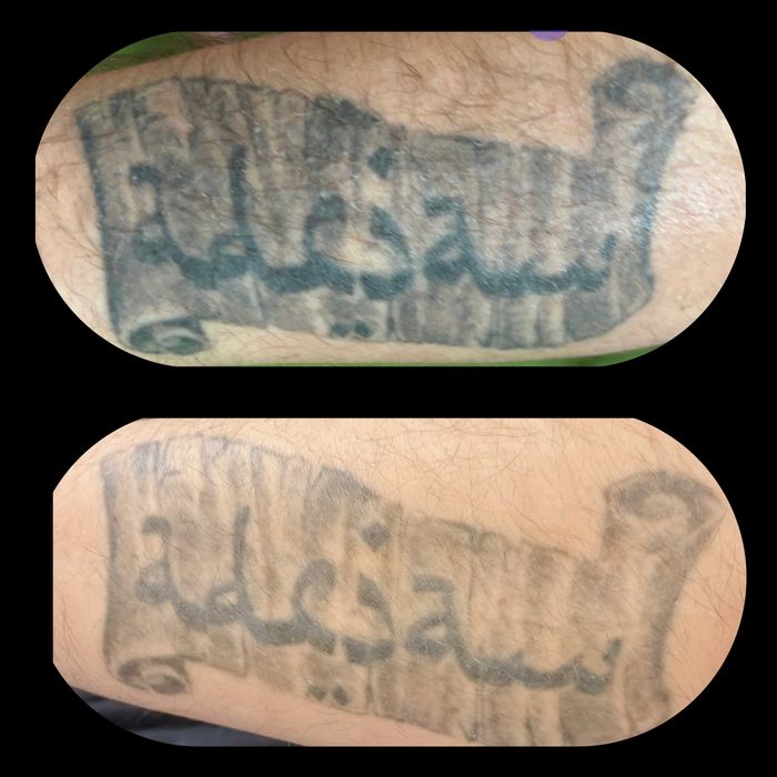 Stergere tatuaje la nivelul sprancenelor si corporale.