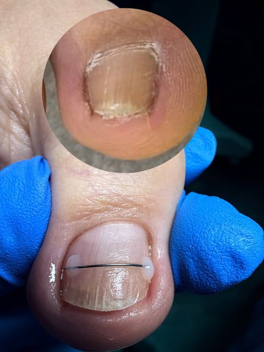 Ичига усган тирнок,Подолог хизмати