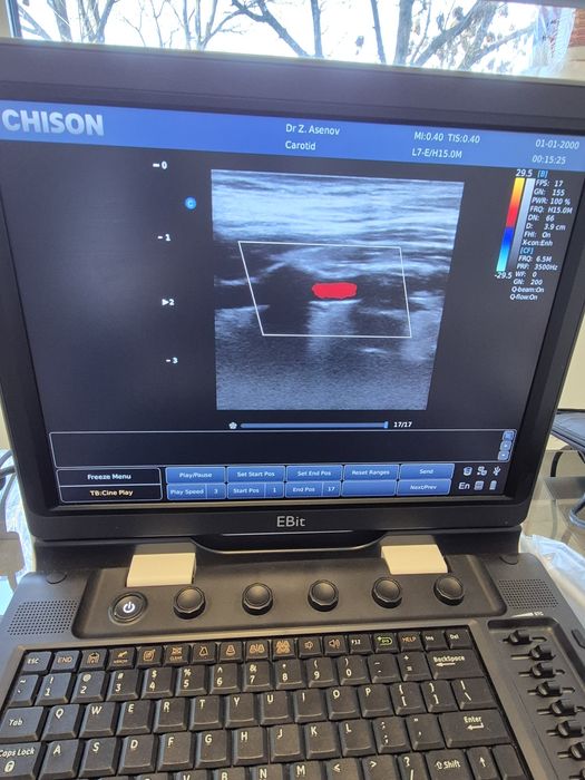 Ехограф Chison EBit 60 (2018) + Линейна сонда –