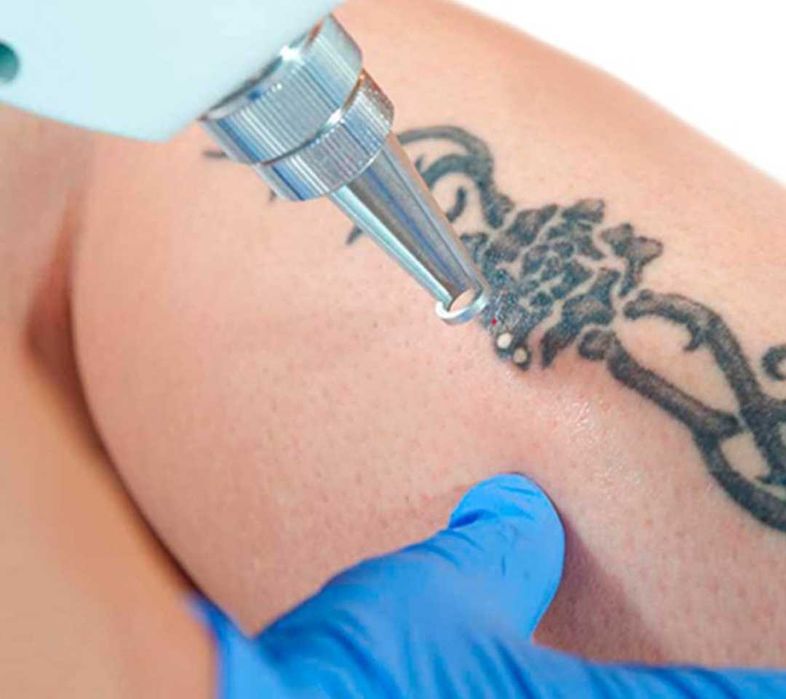 Удаление тату и  татуажа