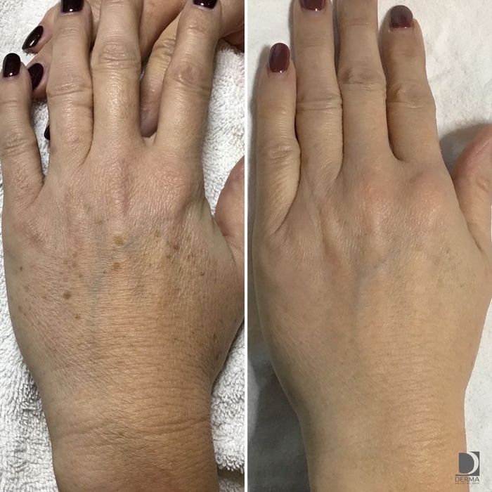 Врач Дерматолог-Косметолог |Чистка лица | Профессиональные процедуры