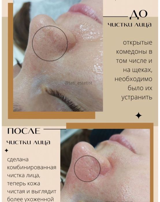 Чистка лица , массаж лица , шугаринг