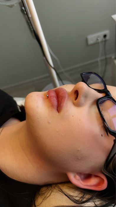 Контурная пластика губ