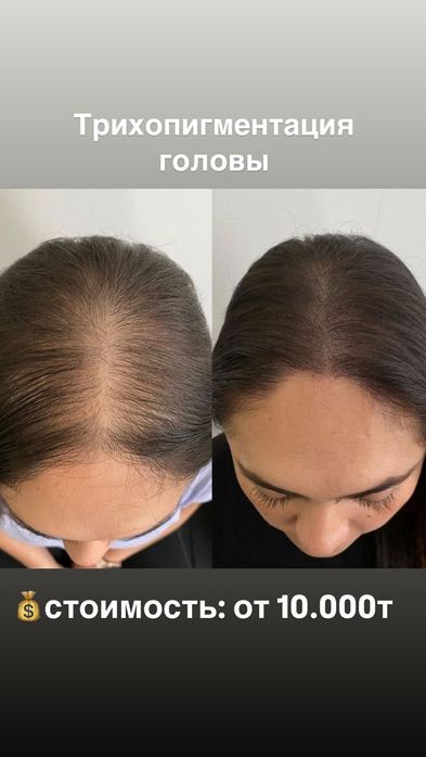 Трихопедментация головы