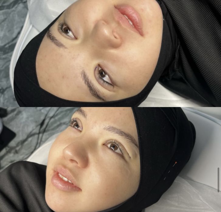 Нитевая блефаропластика