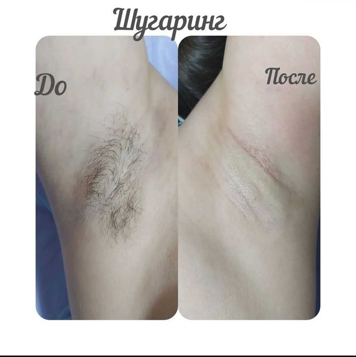 Курсы по Шугарингу " АКЦИЯ "