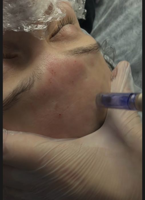 Чистка лица + пилинг 45 квартал