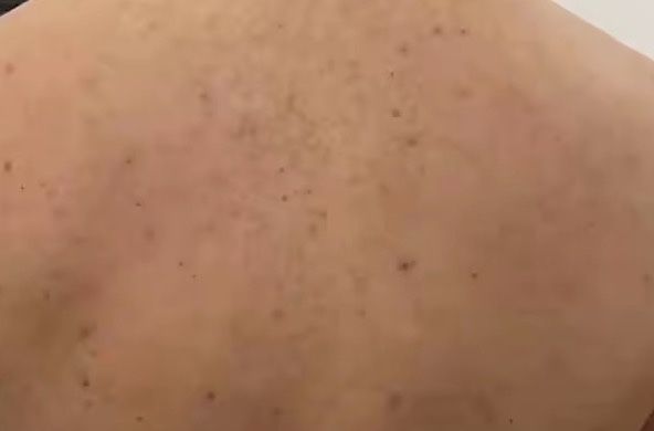 Сапун за тяло и акне