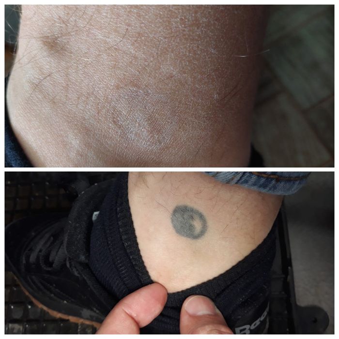 Îndepartare - stergere tatuaje pico laser laser