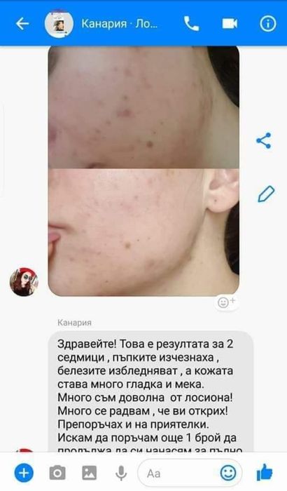 Лосион Против Акне, Мазна Кожа, Разширени Пори и Херпеси - 100мл