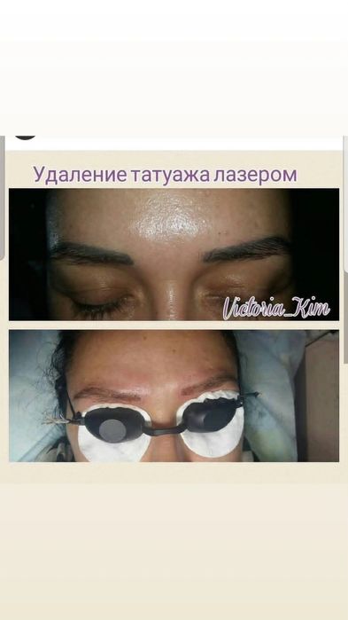 Удаление татуажа лазером 5000т