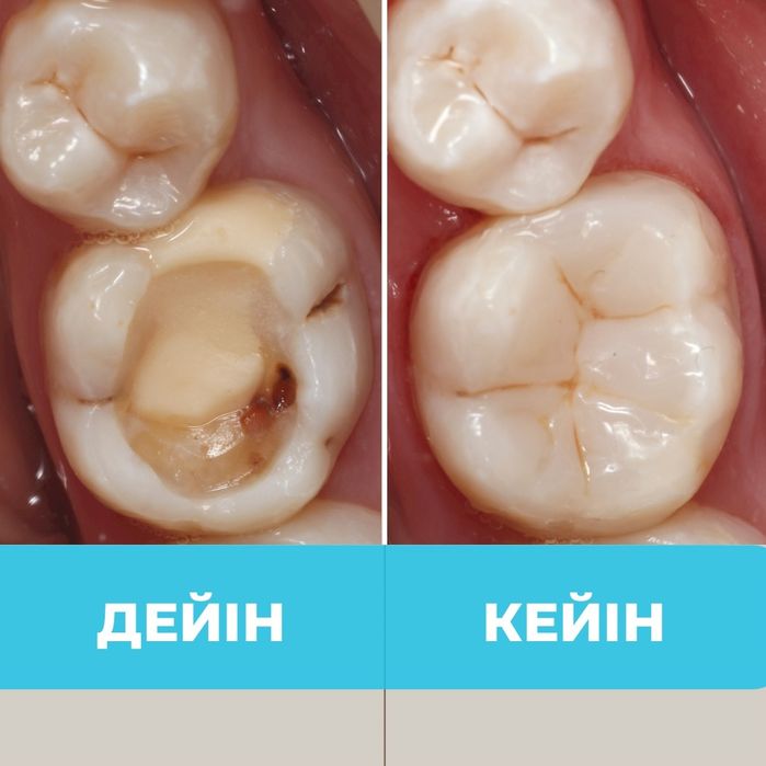 Алматы тіс емдеу , стоматолог