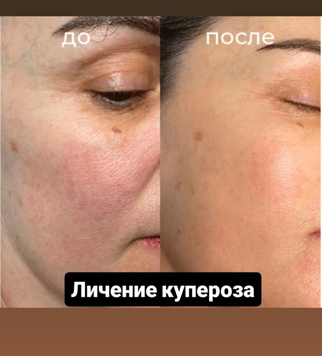 Nd YAG Удаление Татуажа и Татуировки! Мощный лазер!