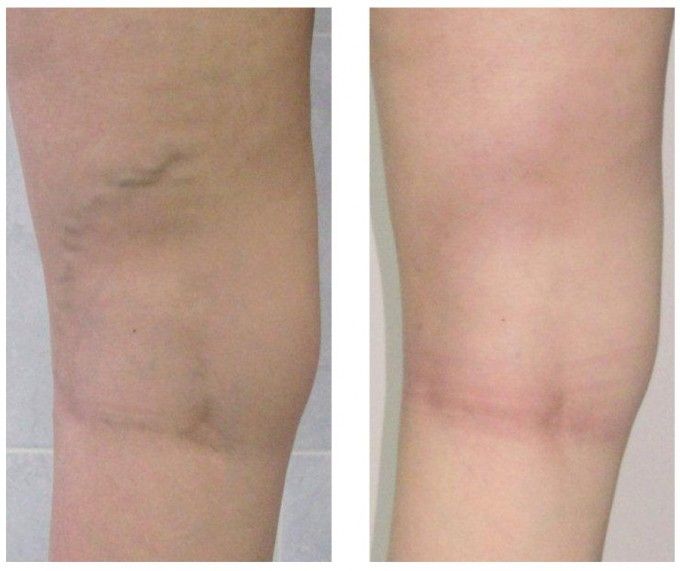 Прессотерапия. Лимфодренаж