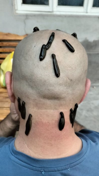 тиббий зулуклар медицинский пиявки гирудотерапия