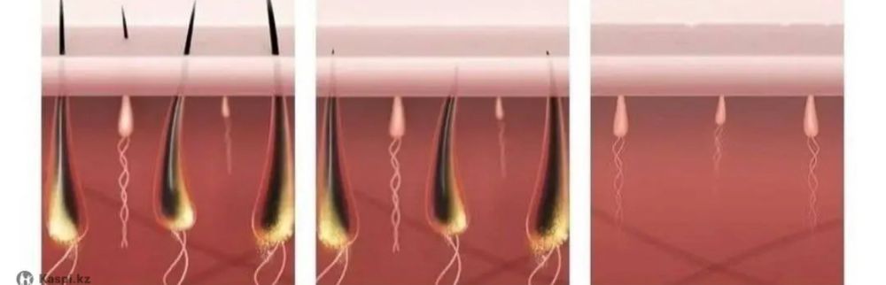 Продам лазерный эпилятор