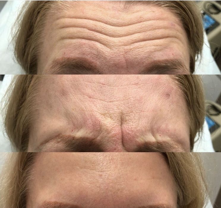 Косметолог блефаропластика,Броулифтинг.Лабиопластика.